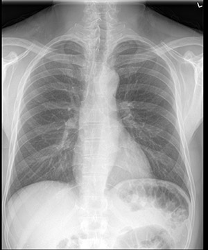 
			标准胸部 X 光检查