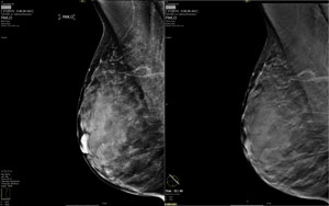 Digital Breast Tomosynthesis Digital 
Breast Tomosynthesis